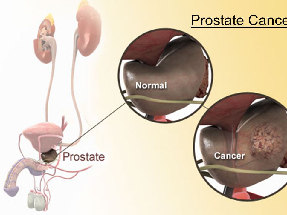 What size of prostate is dangerous